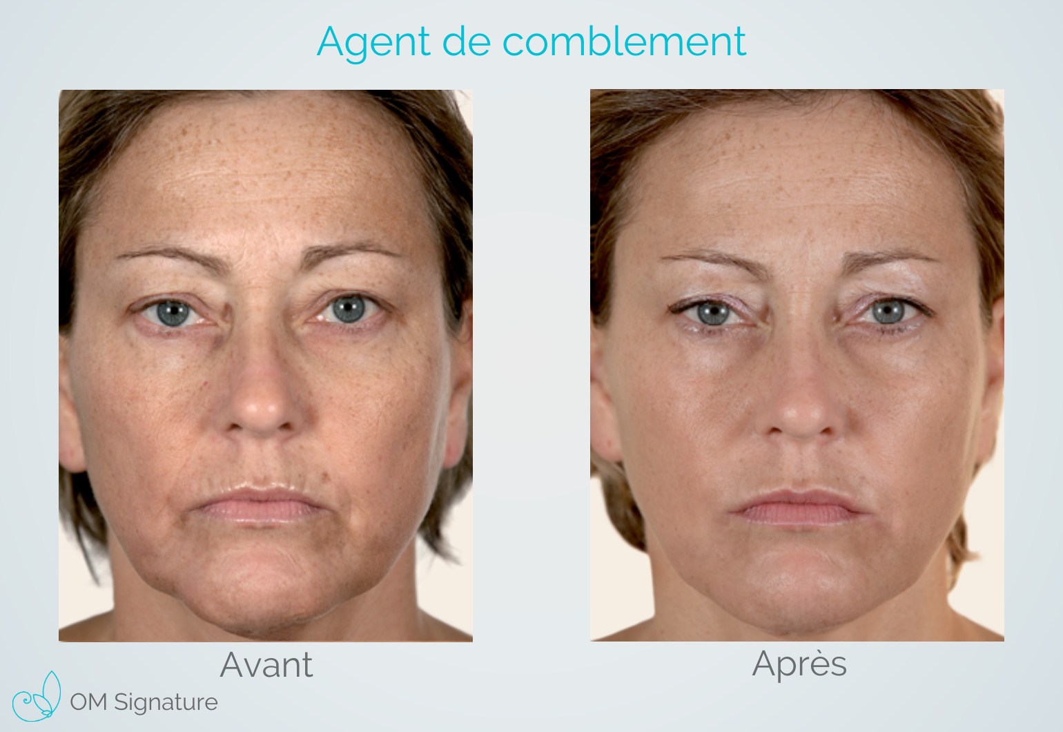 Acide Hyaluronique | Clinique Médico Esthétique à Boucherville Acide Hyaluronique | Clinique Médico Esthétique à Boucherville