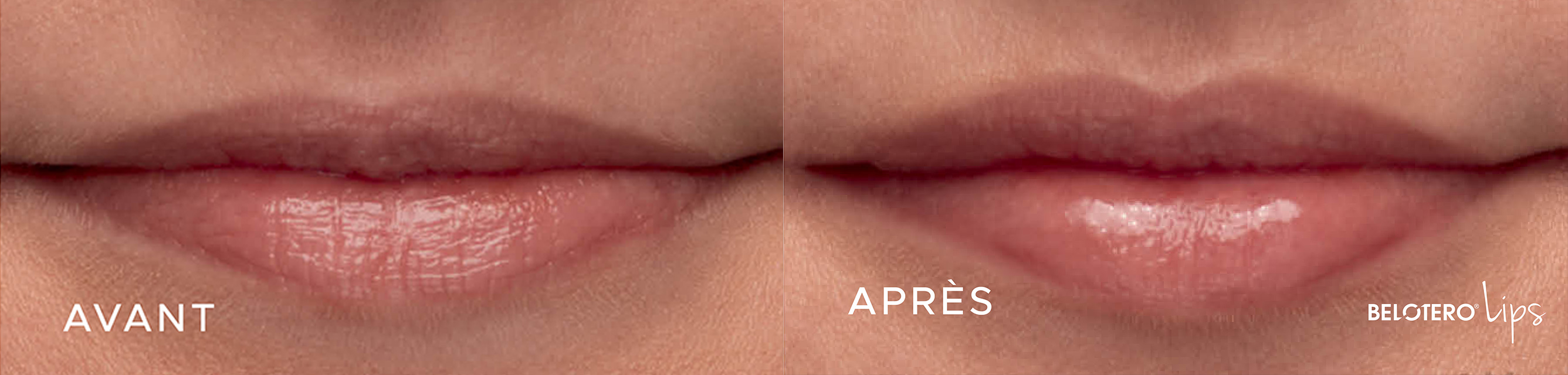 OM-Signature Avant - Après - Traitement des lèvres - Belotero Lips