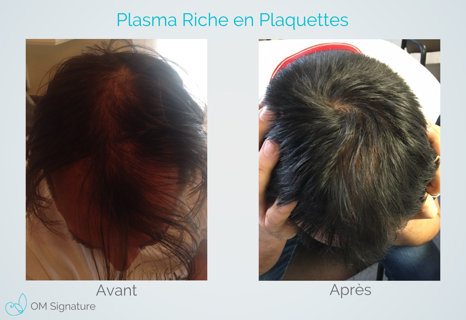 Prp Visage Résultat Au Bout De Combien De Temps Plasma Riche en Plaquettes (PRP) pour la peau et perte de cheveux