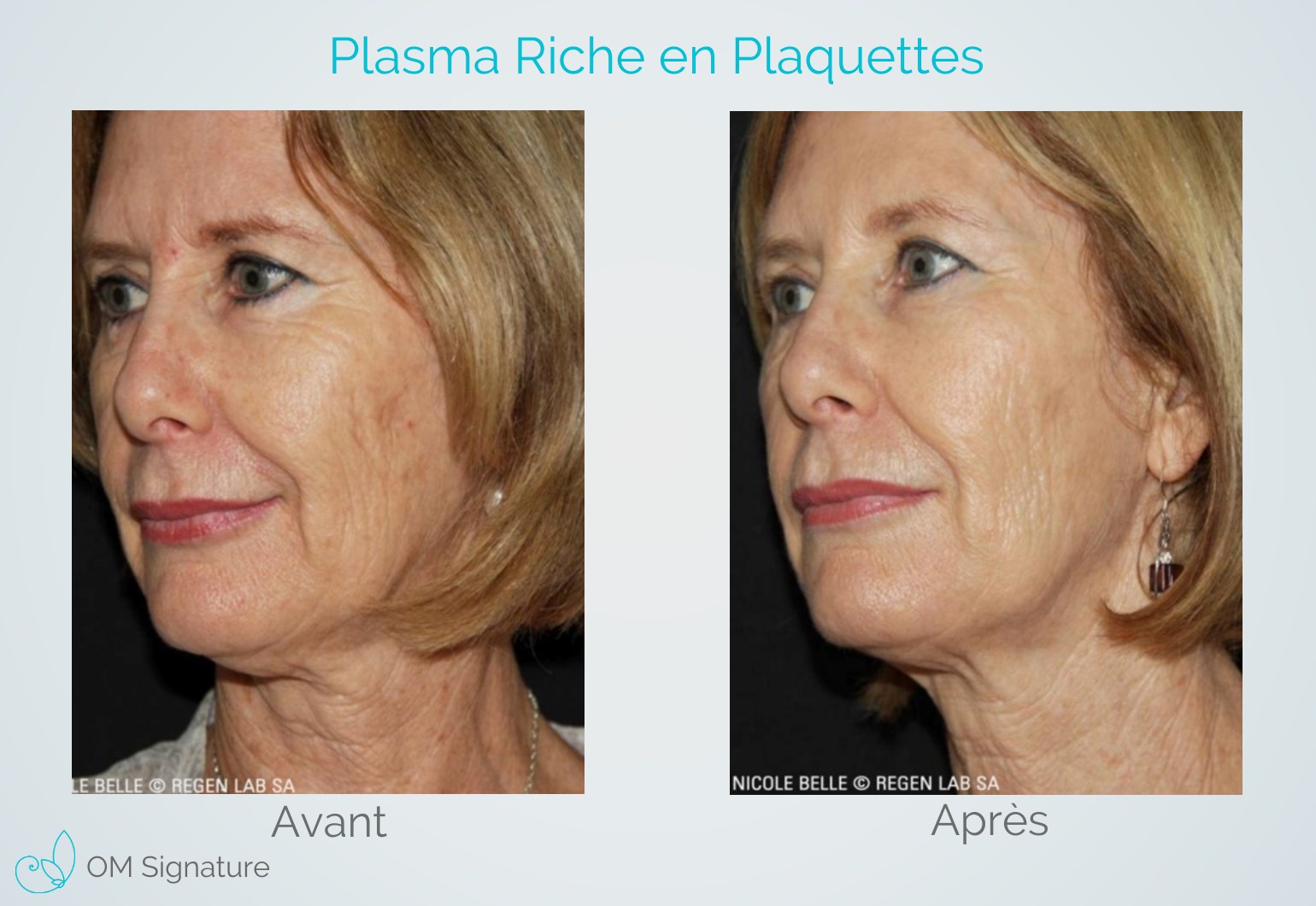 Prp Visage Résultat Au Bout De Combien De Temps Plasma Riche en Plaquettes (PRP) pour la peau et perte de cheveux
