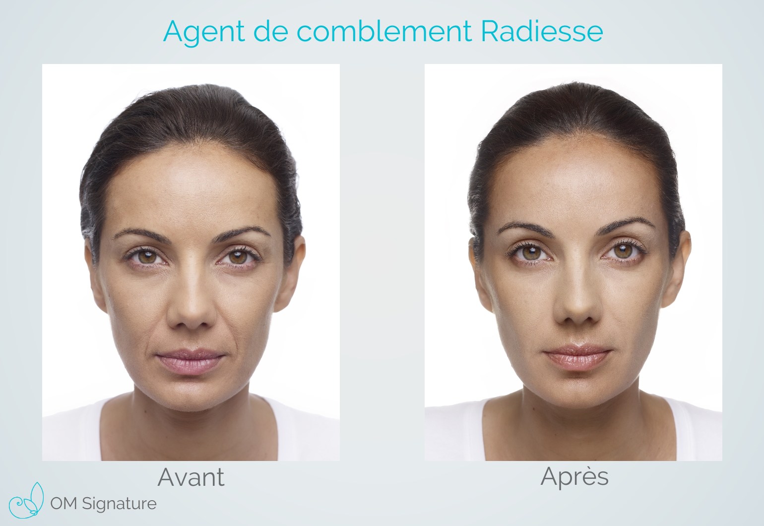 Radiance Injection Injection de Radiesse | Clinique Médico Esthétique à St-Lambert