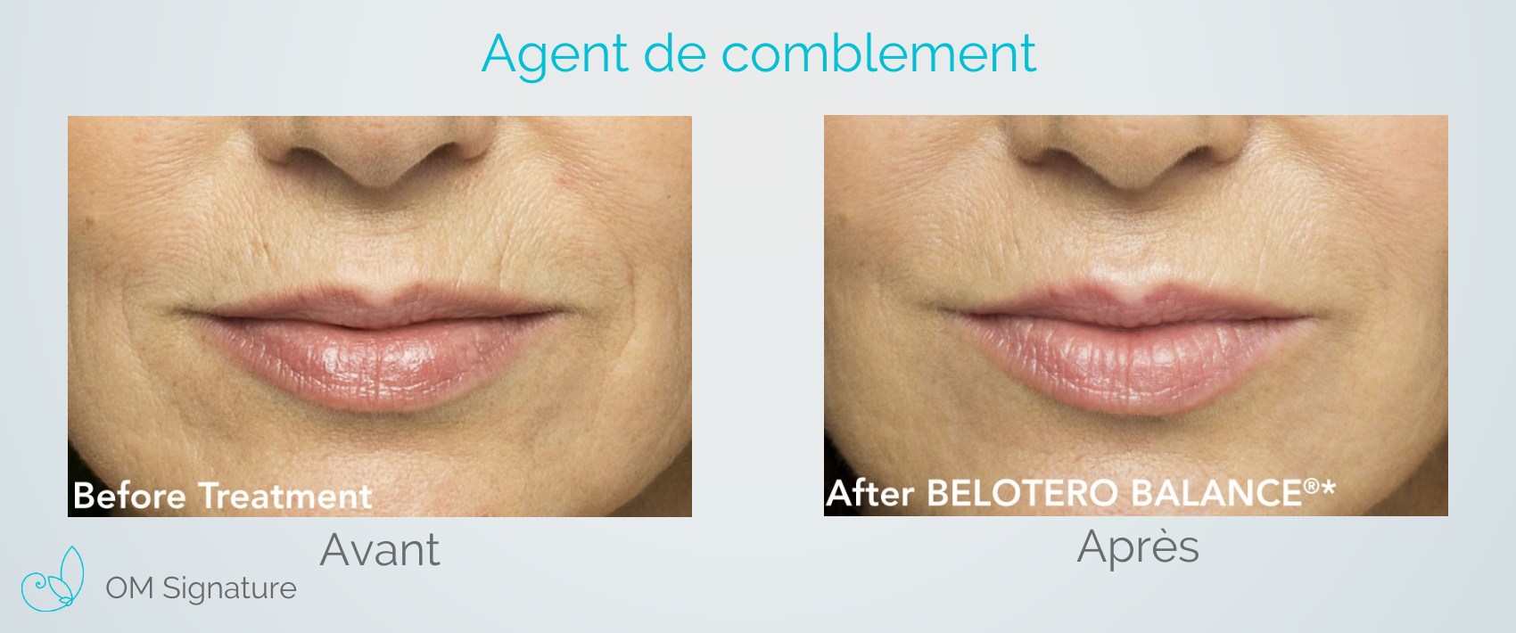 Botox Levres Avant Apres