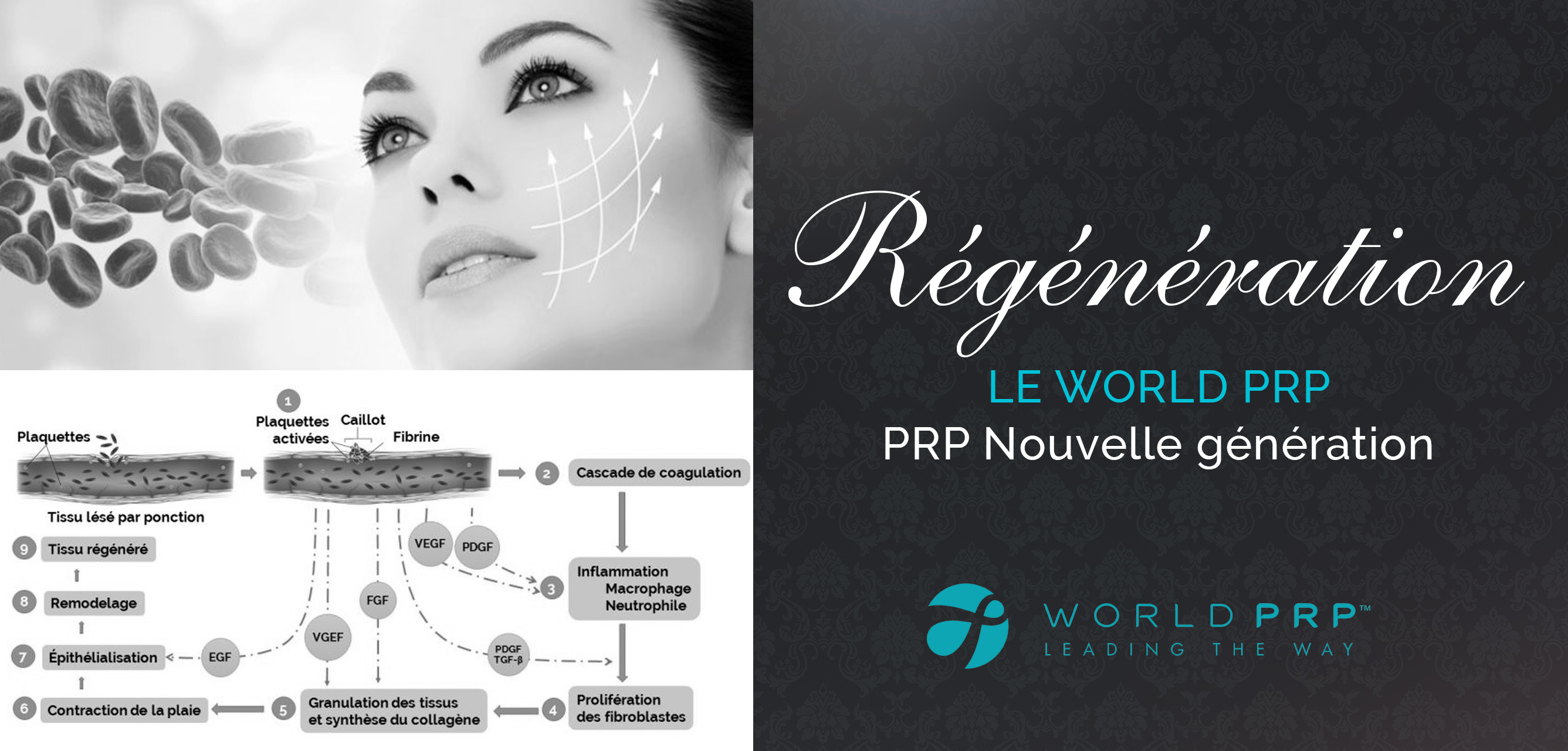 Wolrd PRP - OM Signature - Clinique Esthétique Médicale Rive-Sud