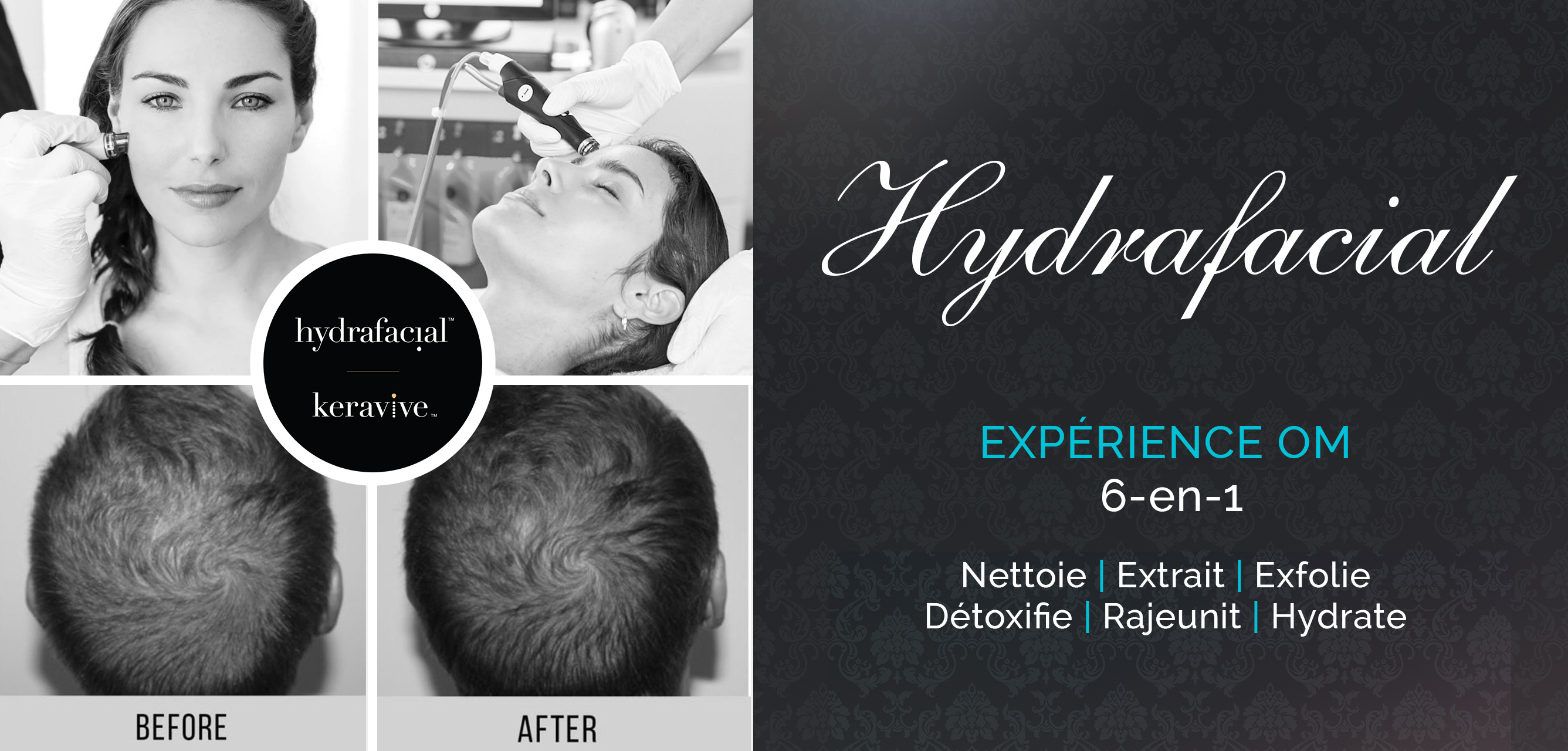 Hydrafacial - OM Signature - Esthetique Medicale - Rive Sud